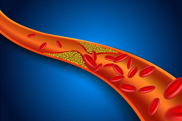 血管プラークのイメージ